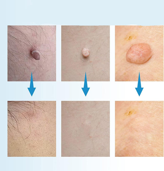 Painless Skin Tag Remover Kit – Easy At-Home Solution for Removing Warts, Moles, and Skin Tags